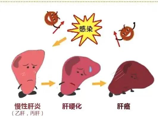 香蕉APP下载视频厂家提醒肝脏疾病治不好？要了解是否含铁食物摄入多